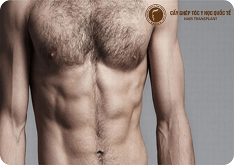 Cấy lông ngực