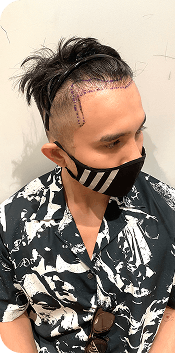 Cấy ghép tóc Y học Quốc Tế