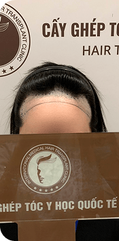 Cấy ghép tóc Y học Quốc Tế