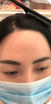 Cấy ghép tóc Y học Quốc Tế