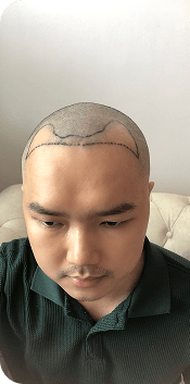 Cấy ghép tóc Y học Quốc Tế