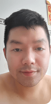 Cấy ghép tóc Y học Quốc Tế