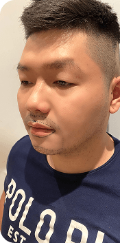 Cấy ghép tóc Y học Quốc Tế