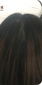 Cấy ghép tóc Y học Quốc Tế