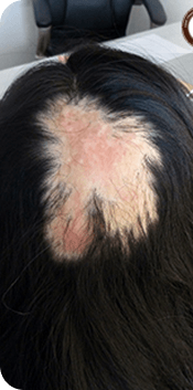 Cấy ghép tóc Y học Quốc Tế