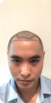 Cấy ghép tóc Y học Quốc Tế