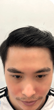 Cấy ghép tóc Y học Quốc Tế