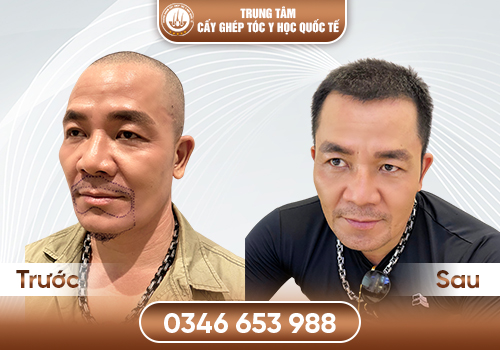 Râu Mọc Không Đều Phải Làm Sao? Giải Pháp Phục Hồi Râu Tự Nhiên