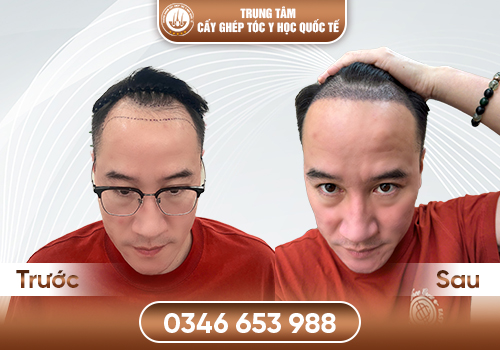 Phương pháp cấy tóc tự thân – Giải pháp phục hồi tóc bằng công nghệ mới nhất hiện nay
