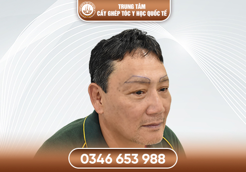 Cấy lông mày cho nam là gì? Tất tần tật thông tin trước khi thực hiện