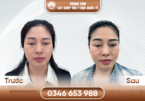 Công Nghệ Cấy Lông Mày Tự Thân – Giải Pháp Cho Hàng mày Thưa, Nhạt