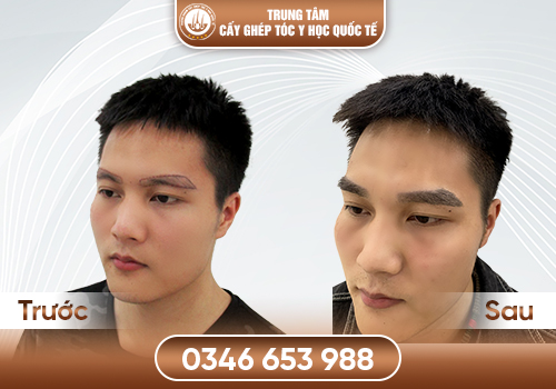 Cấy chân mày là gì? Quy trình, chi phí và những điều cần biết trước khi thực hiện