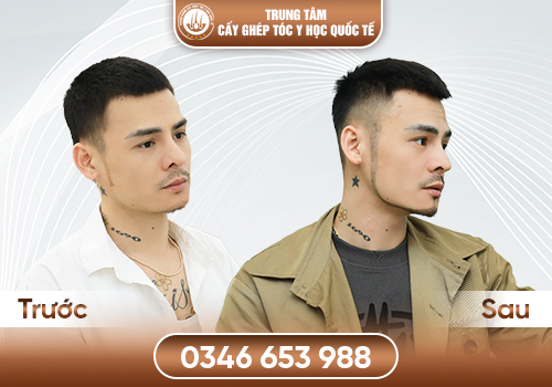 Chi Phí Cấy Râu Bao Nhiêu Tiền? Giải Đáp Chi Phí Cùng Chuyên Gia