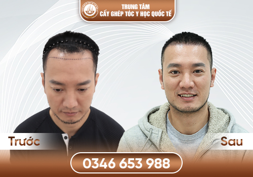 Hói có chữa được không? Chuyên gia nói gì về khả năng phục hồi tóc?