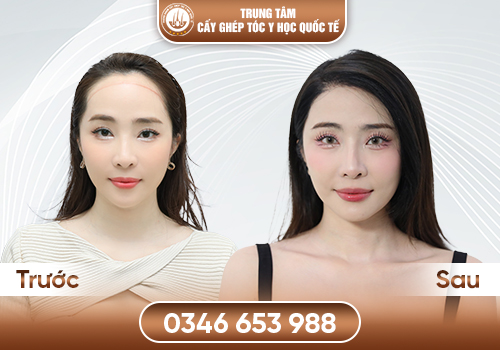 Địa chỉ cấy tóc uy tín – Gợi ý cơ sở cấy tóc an toàn, chuẩn y khoa hiện nay