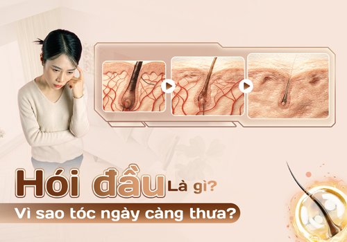 Hói đầu: Dấu hiệu nhận biết – Nguyên nhân và cách cải thiện hiệu quả 